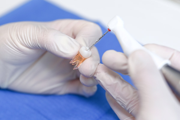 Wurzelbehandlung Wurzelkanalbehandlung Endodontie Lauterbach